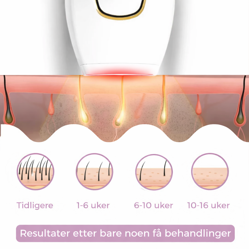 Glowera IPL Hårfjerner | Den ledende laserhårfjerneren for hjemmebruk