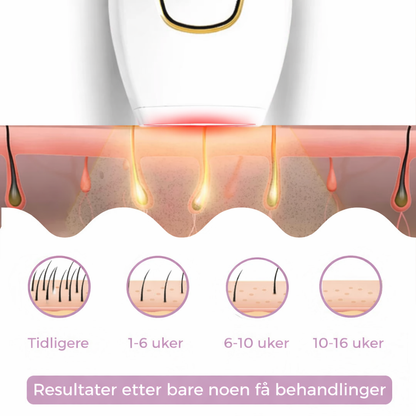 Glowera IPL Hårfjerner | Den ledende laserhårfjerneren for hjemmebruk