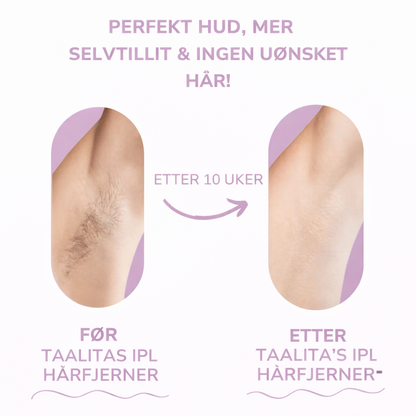 Glowera IPL Hårfjerner | Den ledende laserhårfjerneren for hjemmebruk