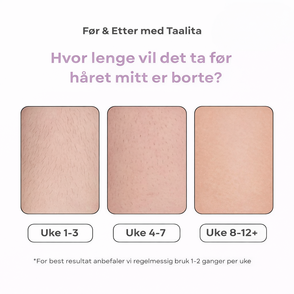 Glowera IPL Hårfjerner | Den ledende laserhårfjerneren for hjemmebruk