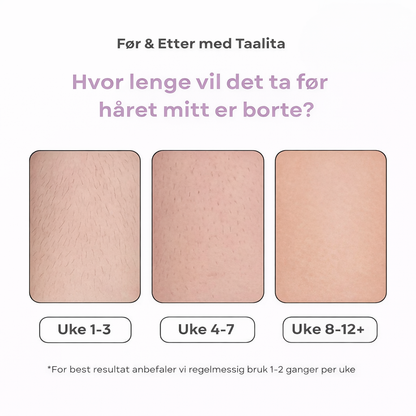 Glowera IPL Hårfjerner | Den ledende laserhårfjerneren for hjemmebruk